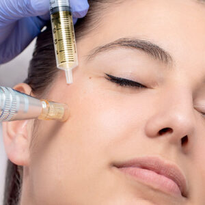 PLASMA RICO EN PLAQUETAS FACIAL